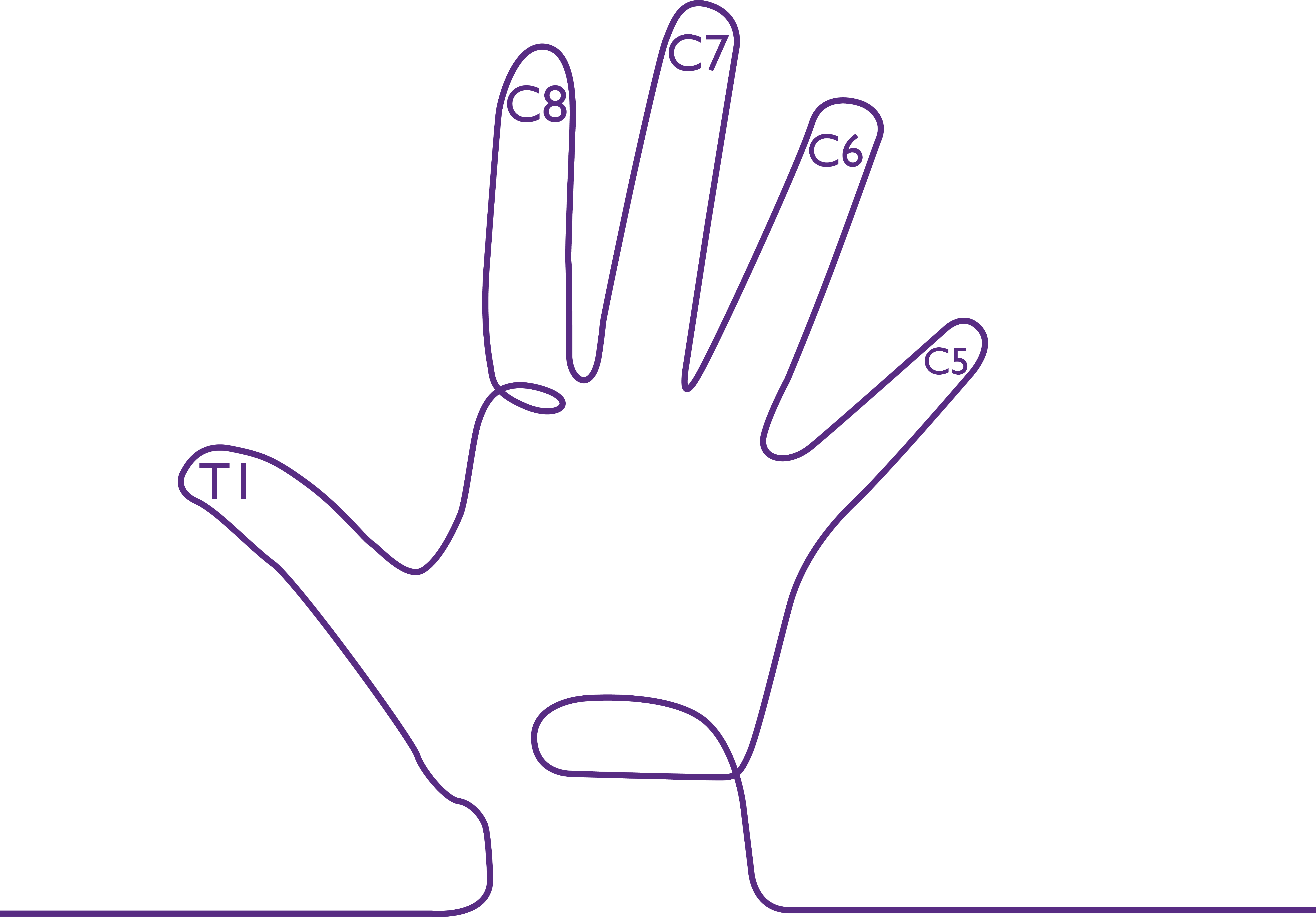 Erb's Palsy Hand_Purple